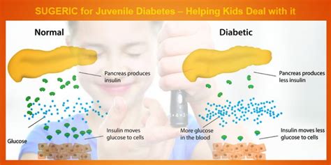 Juvenile Diabetes Helping Kids Deal With It