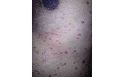 Guttate Psoriasis Symptoms Causes And Treatments Tibot