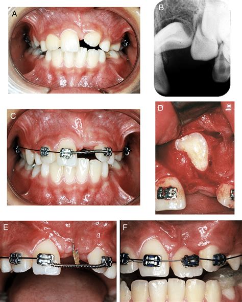 Orthodontic Surgical Endodontic Management Of Unerupted Maxillary