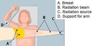 Brachial Plexus - The Injury Of Nerves: Radiation Induced-Brachial ...