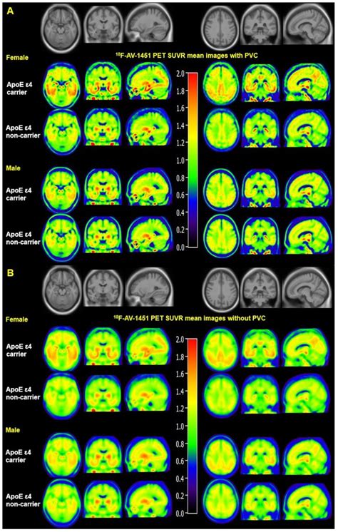 Sex Modulates The Apoe ε4 Effect On Brain Tau Deposition Measured By