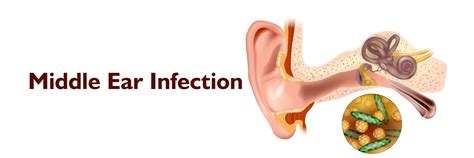 Middle Ear Infections Symptoms Treatments And Prevention