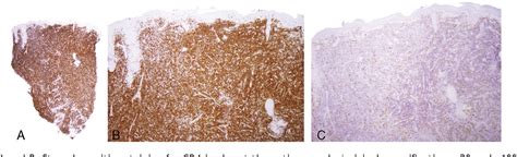 Primary Cutaneous CD4 Small To Medium Sized Pleomorphic T Cell