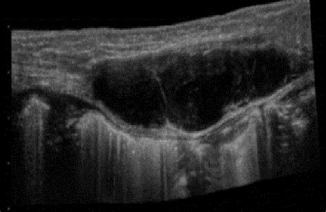 A Usg Image Of The Rectus Sheath Hematoma Download Scientific Diagram