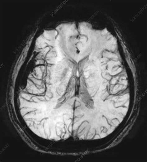 Temporal Lobe AVM on MRI - Stock Image - C027/1587 - Science Photo Library