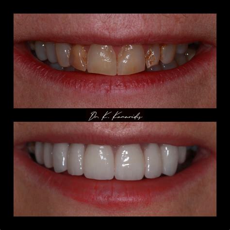 Gallery - Radiant Dental Lab