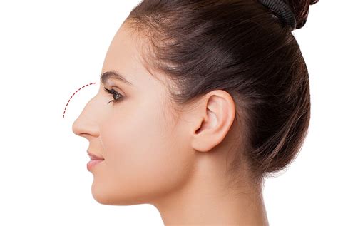 Bump on Nose or Crooked Nose Non-Surgical Rhinoplasty Treatment at ...