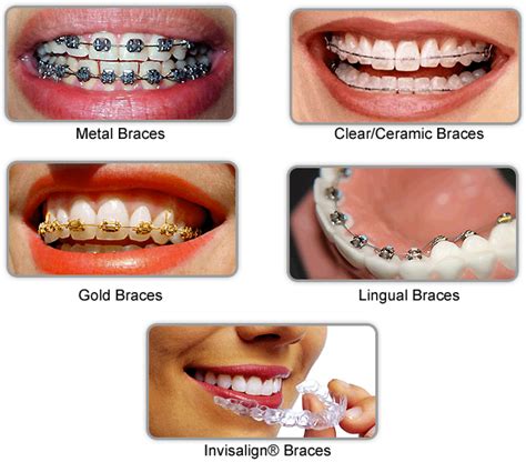 Harga Braces Kerajaan Braces Services In Melaka Pendakap Gigi Klinik