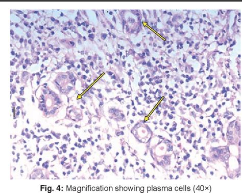 Figure 1 From Küttners Tumor Of The Submandibular Gland A Rare Case