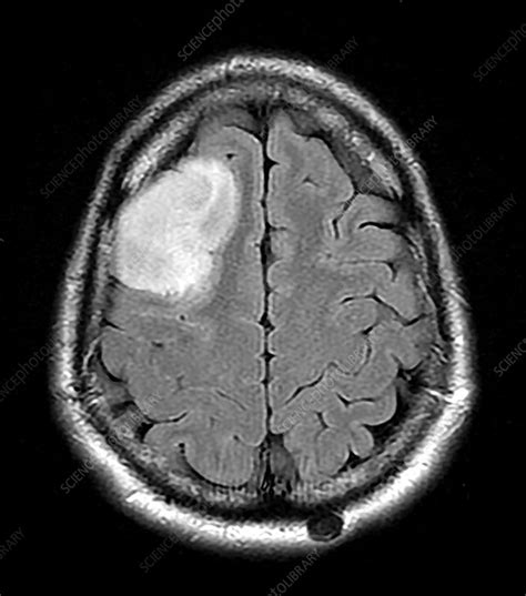 Anaplastic Astrocytoma MR - Stock Image - C043/3123 - Science Photo Library