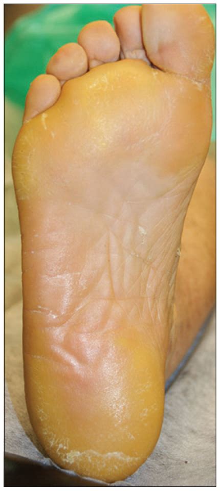 Cutaneous Toxicity Of A New Braf Inhibitor Lgx Encorafenib