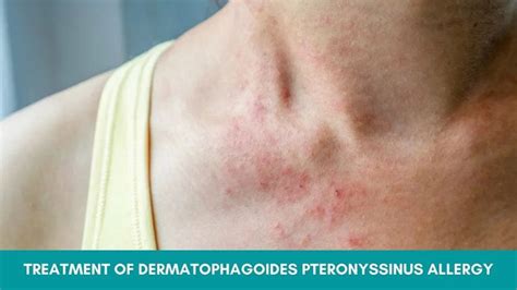 How To Treat Dermatophagoides Pteronyssinus Allergy Naturally