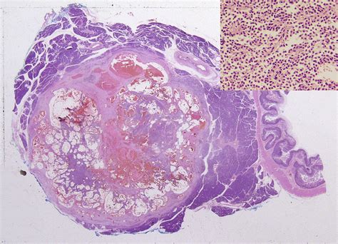 Understanding Pancreatic Pathology Surgery Oxford International Edition