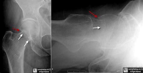 learning radiology fractures   proximal femur