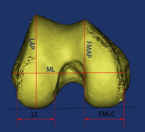 The Image Is A Three Dimensional Schematic Of The Femoral Condyle