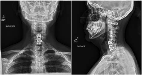 Cervical Spine X Ray 2 Weeks After The Revision Surgery Pa Left And Download Scientific