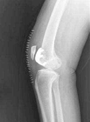 Patello Femoral Replacement Orthowood