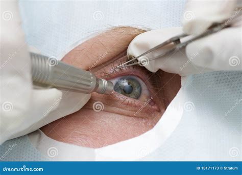 Treatment of an Eye by Ultrasound Stock Image - Image of macro, hospital: 18171173