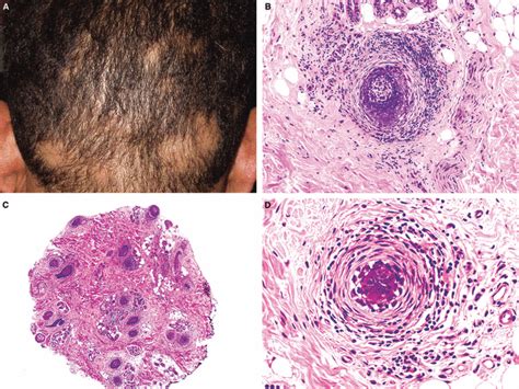 Scarring Alopecia Histology