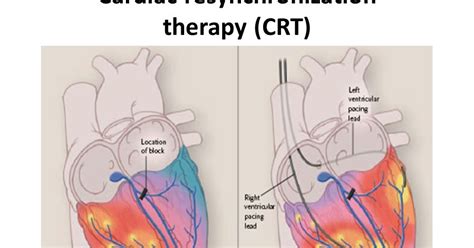 Dr Han Naung Henry Han Electrophysiology And Heart Rhythm Crt