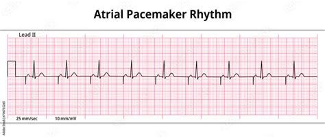 ECG Atrial Pacemaker Rhythm - Single Chamber - 8 Second ECG Paper - Electrocardiogram Vector ...