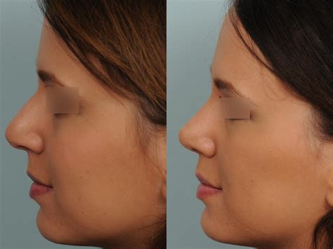 Photos De Rhinoplastie Avec Nez Trop Large Avant Et Apr S R Duire Le Nez