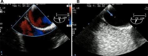 Echocardiogram Tee Pfonotes Tee Showed A Very Minor P Open I