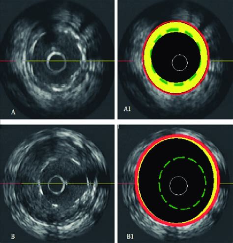 Ultra Sonografia Intracoron Ria Em Dois Momentos Distintos A E A