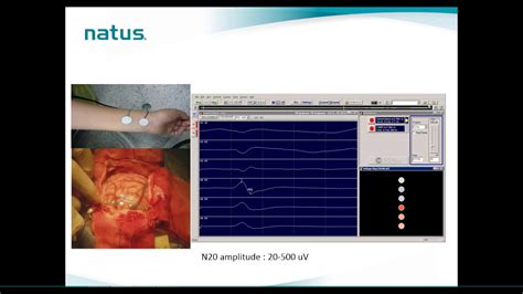 Natus Iom Webinar Brain Mapping Technique In Iom Youtube