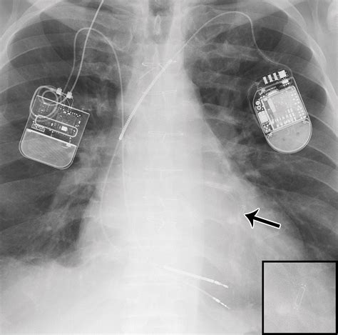 Radiographic Review Of Current Therapeutic And Monitoring Devices In