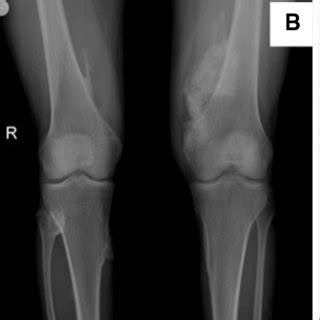 Anteroposterior Plain Radiographic Images Of The Knees A January