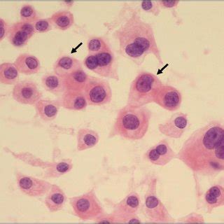 Microphotograph From The Cytology Smear Showing Eosinophilic Granular