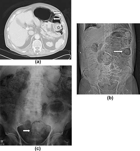 Imaging Manifestations Of Faecal Impaction And Stercoral Perforation