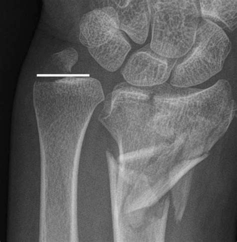 Ulnar Styloid Avulsion Fracture