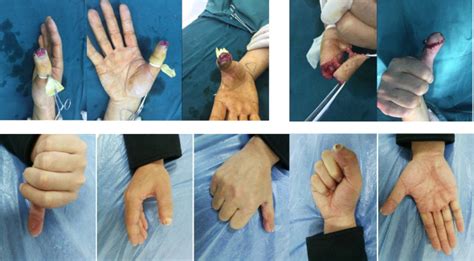 Reconstruction Of Fingertip Defects With The Anterograde Homodigital Neuroarterial Island Flap