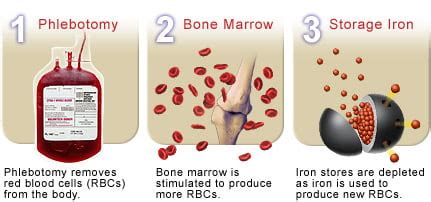 Therapeutic Phlebotomy Explained - E Phlebotomy Training