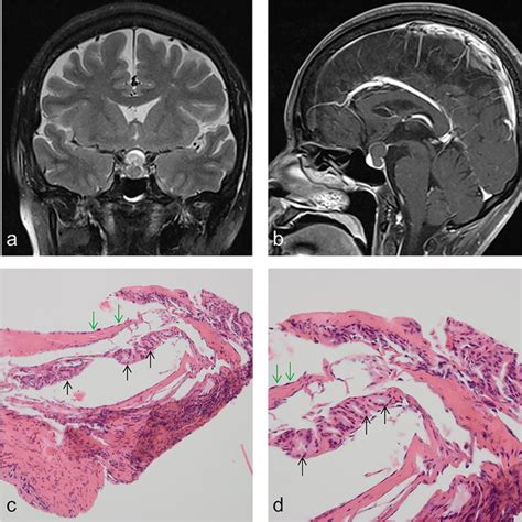 Magnetic Resonance Imaging Mri And Histopathology Of Case 2 A B