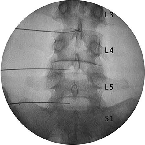 Discography At 3 Levels L3 L4 L4 L5 And L5 S1 All In Anteroposterior Download Scientific