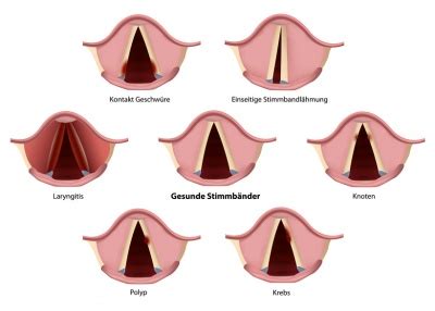 Kehlkopfentz Ndung Ursachen Symptome Behandlung Medlexi De