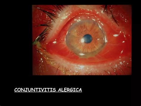 Enfermedades Inflamatorias De La Conjuntivitis Ppt Descarga Gratuita