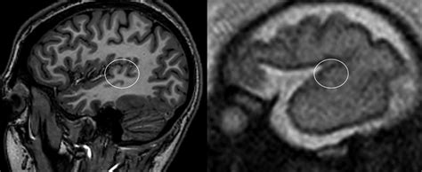 Fetal Mr Imaging Anatomy Of The Transverse Temporal Gyrus Heschl Gyrus