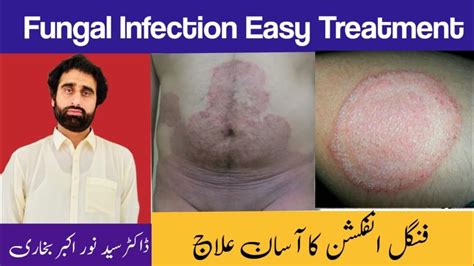 Ring Worm Treatment Tips For Fungal Infection Treatment Daad Ka Ilaj