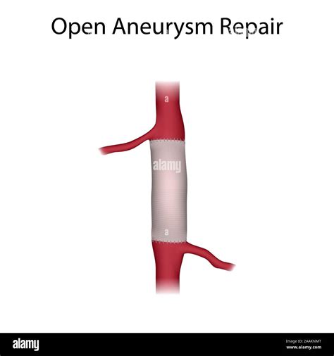 Aneurysms Hi Res Stock Photography And Images Alamy