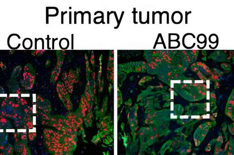 Genetic Switch Turns Tumor Suppressor Into Oncogene In Colorectal Cancer