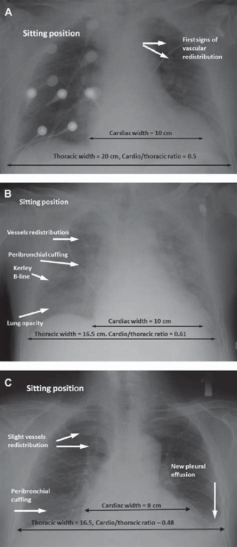 A Series Of Chest X Rays Cxrs Showing Redistribution A Alveolar