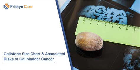 What Size Is Considered A Large Gallstone Gallbladder Cancer