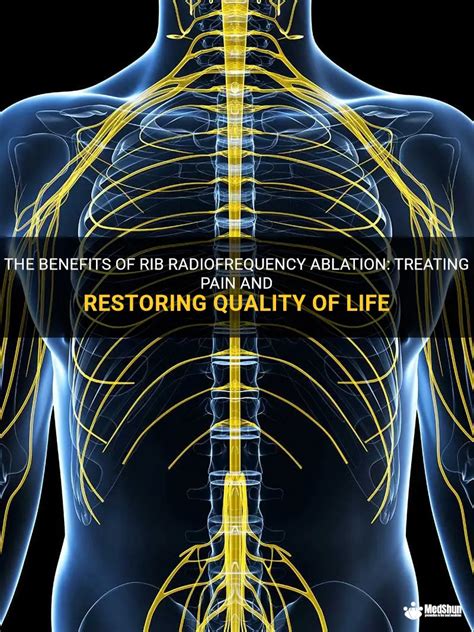 The Benefits Of Rib Radiofrequency Ablation Treating Pain And