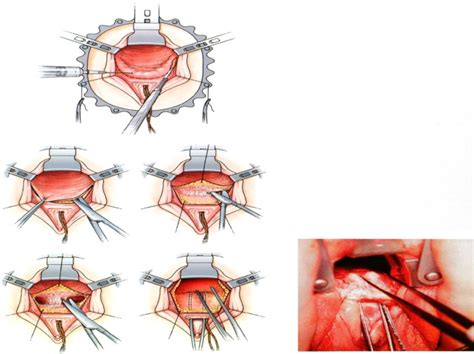 Management Of Symptomatic Urethral Diverticula In Women A Single