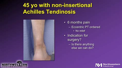 Insertional Achilles Tendonitis