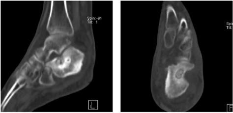 Computed Tomography Images Demonstrating The Lesion With A Sclerotic